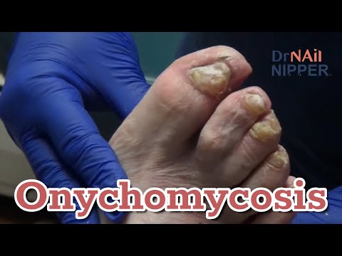 Throwback - Doc Returns! Thick Toenails, Onychomycosis and Story 1