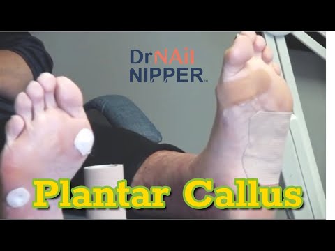 Many Plantar Callus - Throwback 1