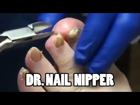 Dr. Nail Nipper's A Hero! Saving Feet and Lives! Beautiful Treatment Video 1