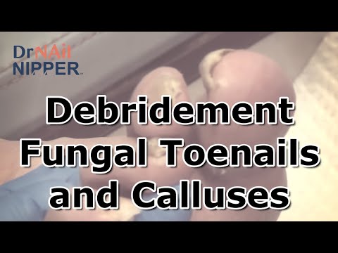 Throwback - Wound Debridement Fungal Toenails, Calluses and Foot Pain 1