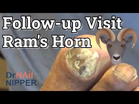 Follow-up Visit of Best Ram's Horn ALL YEAR. How to care for thick toenails? FEET-ure Friday (2022) 1