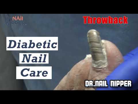Diabetic Nail Care - Clipper, Medicool Drill, Curette 1