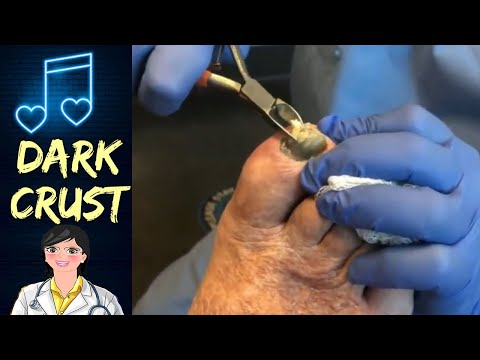 Crusty Nail Highlights 1 - Nails and Music 1