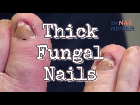 Throwback - Thick Fungal Toenails 1