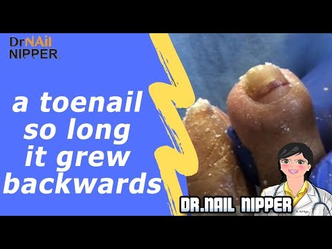 How do Toenails Grow in Backwards? Long Toenail Grew In Backwards and Dr Nail Nipper is Ready 1