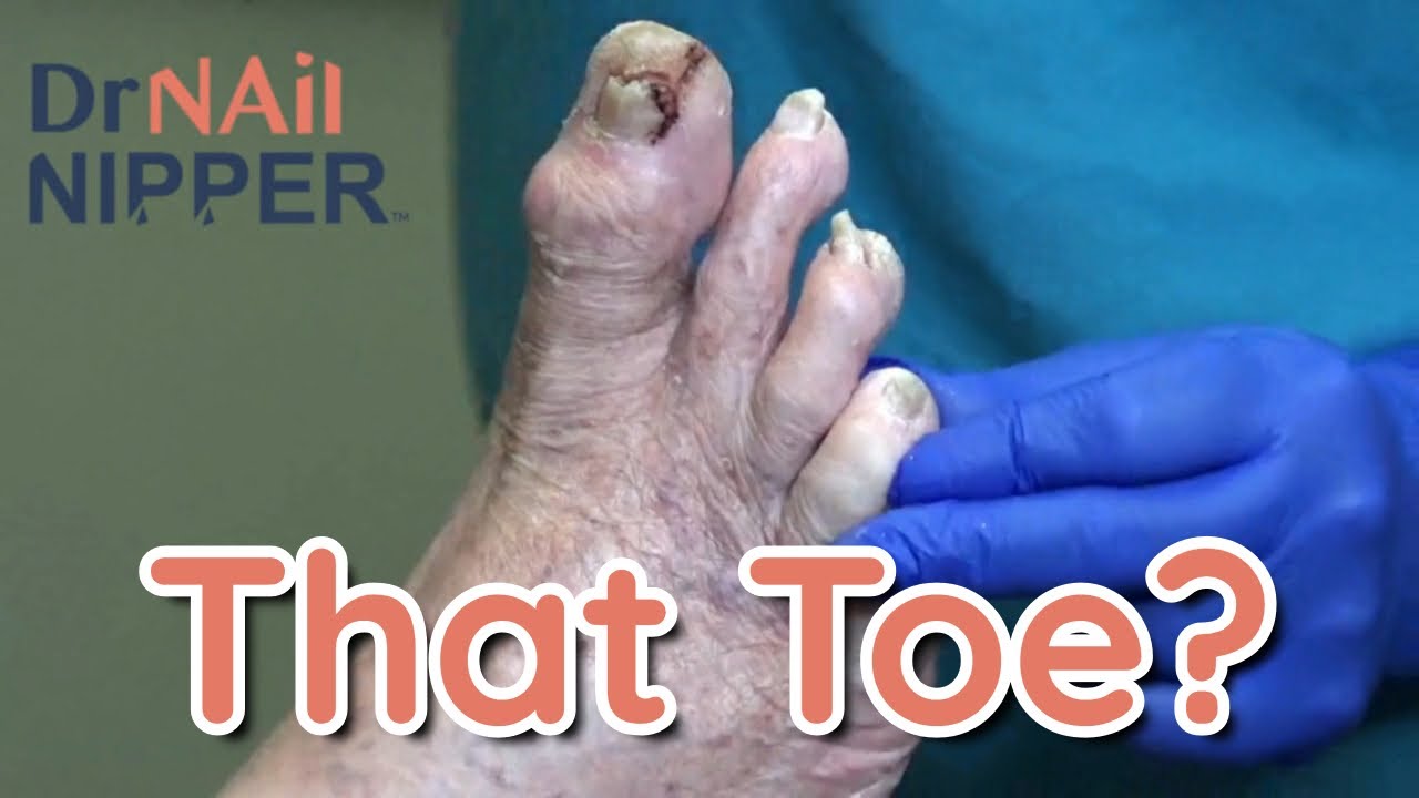 Throwback Total Toe and Nail Care with Calluses 1