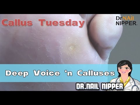 Do you hear the Deep Voice? It is about the Calluses [Callus Tuesday] (2018) 1