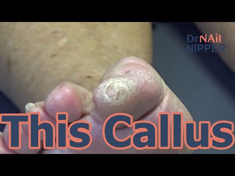 Throwback - Corns and Callus 1