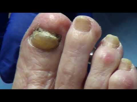 What causes thick toenails? The Baker and her Thick Toenails and Callus Trimming 1