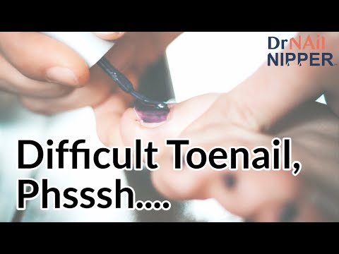 Difficult Toenails - Throwback 1
