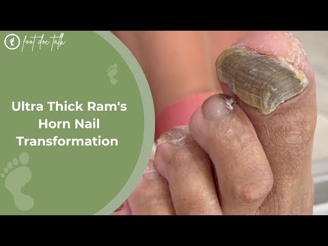 Ultra Thick Ram's Horn Nail Transformation 1