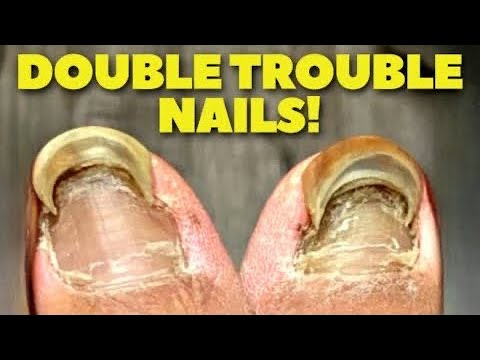 Did Tight Shoes Cause These Double Nails?! (INTENSE, LAYERED Nail Cutting) 1