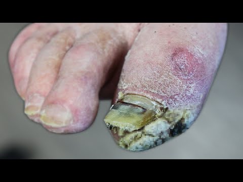 WHAT'S GROWING ON HIS FOOT? ***THICK SKIN OR FUNGUS?*** 1