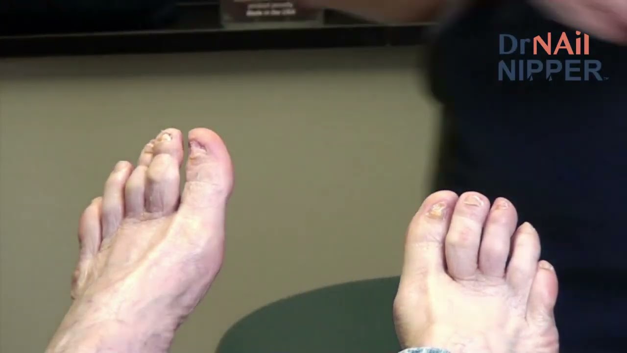 Throwback Thursday - Hammertoe 5