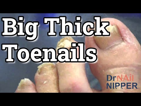 Big Thick Toenails. FEET-ure Friday (2022) 1