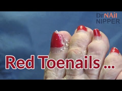 Red Toenails, One Hurt, Nine Toenails Trimmed. FEET-ure Friday (2022) 1