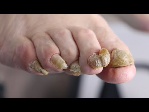 TRIMMING SUPER LONG TOENAILS ***NEVER CUT FOR OVER 2 YEARS*** 1