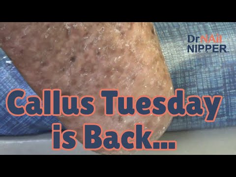 Callus Tuesday is Back (2022) 1