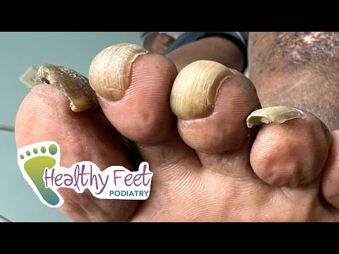 NAILS KEEP GROWING INTO THE SKIN! 1