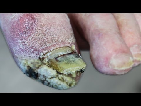 DID IT GROW BACK ON HIS FOOT? ***DIABETIC FOOT GROWTH UPDATE*** 1