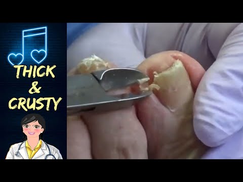 Crusty Nail Highlights 2 - Nails and Music 1