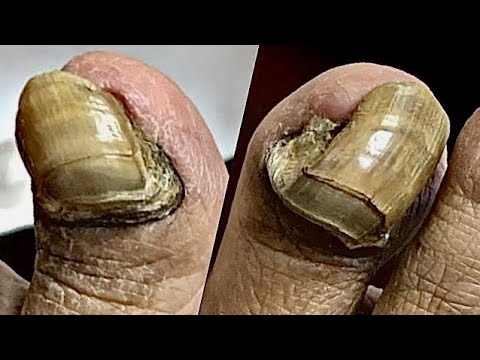 Extremely THICK and Sensitive NAIL CUTTING! **Patient Had To Be Numbed!! 1