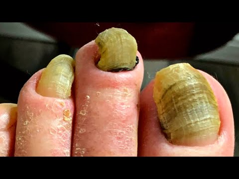 Toenail Cutting on Thick, Crunchy, Layered Nails! | Dr. Kim, Kim Foot and Ankle 1