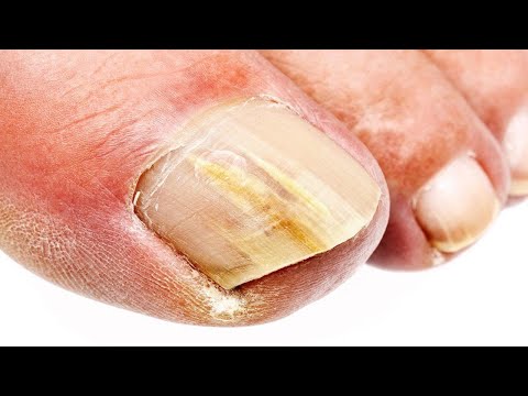 Summer Crusty Nails and Calluses - and Music 1