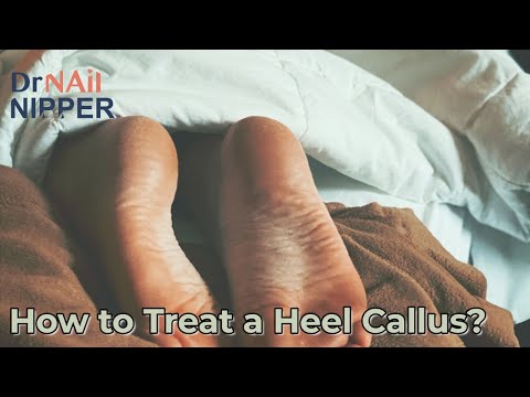 Throwback - How to Treat a Heel Callus? Thick Heel Calluses 6