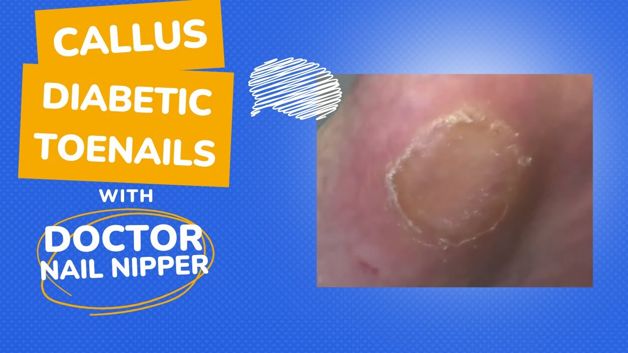 Member Throwback - Callus and Diabetic Toenails 1