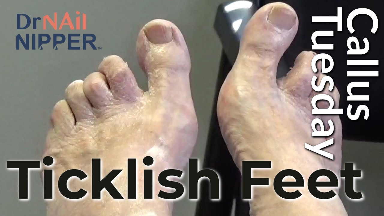 Are feet ticklish? Patient has sensitive toes and toenails for Dr Nail Nipper (2022) 1