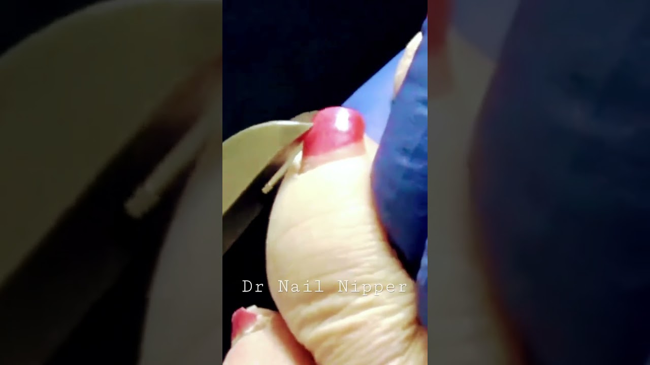 More Diabetic, Foot Sensation with Dr Nail Nipper 1