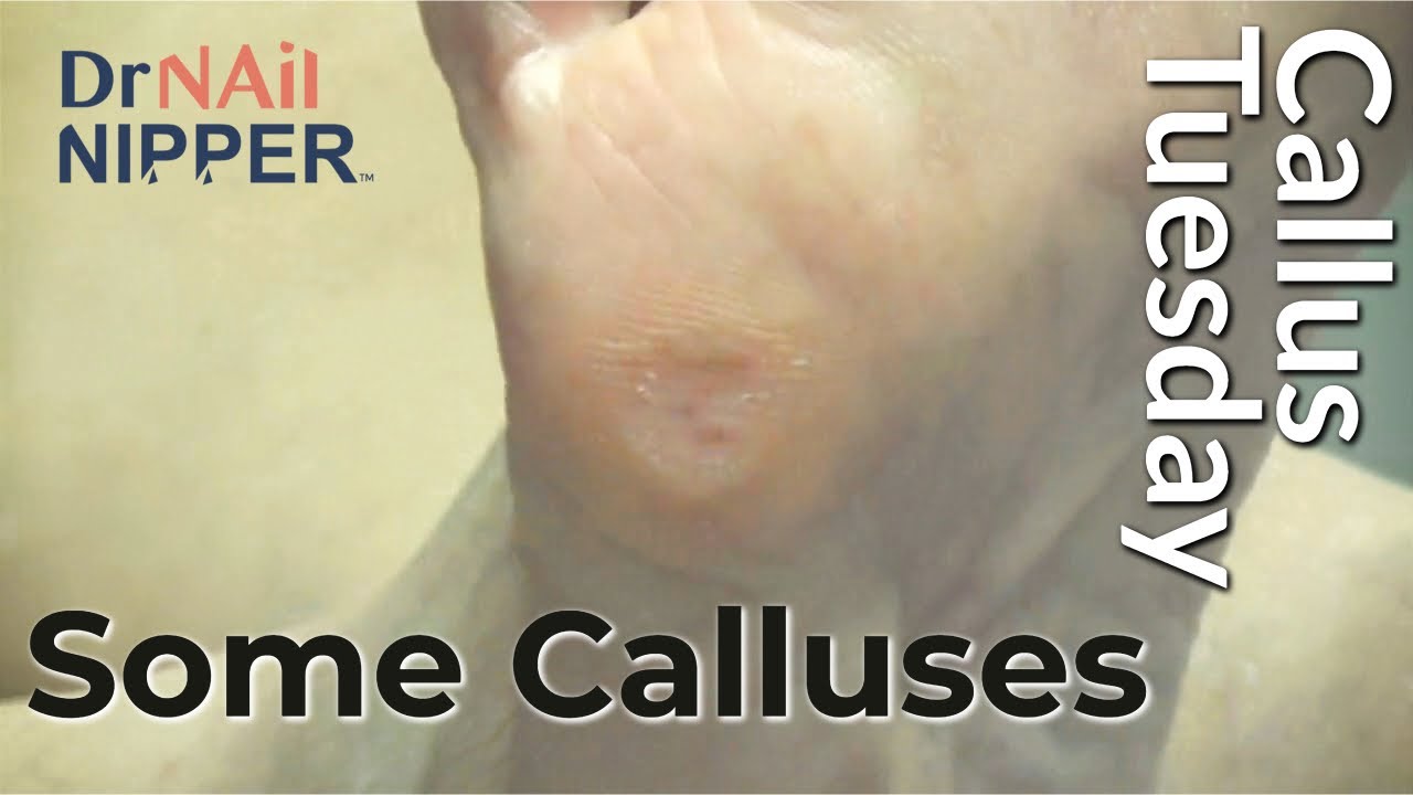 Some Callus Tuesday on a Wednesday (2022) 1