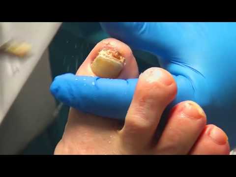 Thick Toenail Cutting! Dr. Nail Nipper's Toughest Nails!! 👍👍👍👍 1