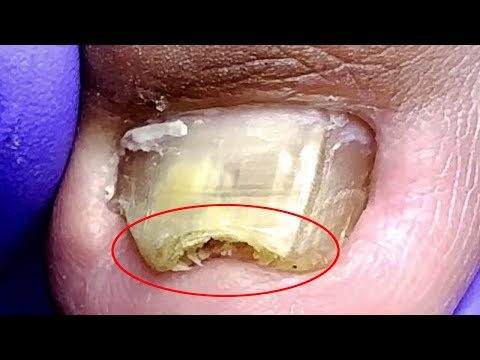 There is treasure under the toenails! clean it carefully【Doctor Liu Pedicure】 1