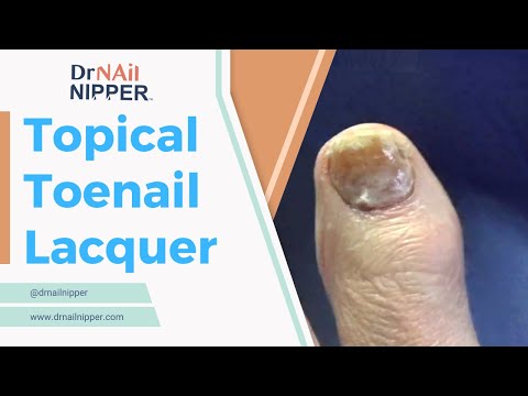 He used topical toenail lacquer. Callus Tuesday on a Wednesday (2022) 1