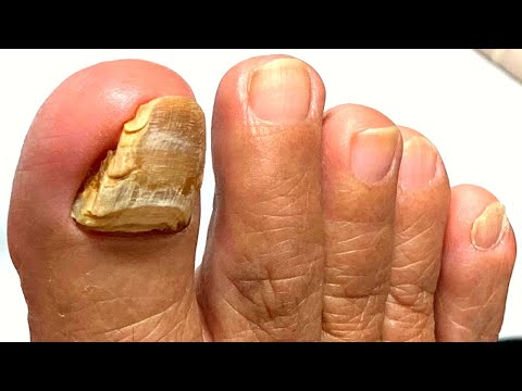 Too Sensitive To Cut?! SUPER THICK Layered Nail Cutting! 1