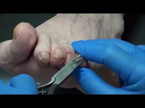 Thick Nails! Dr. Nail Nipper! 1