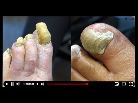 THICK TOENAIL TRIMMING SPECIAL 🤤✄🦶 #toebroclip 1