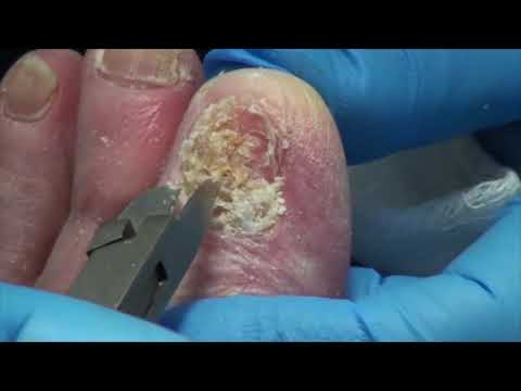 Thick Fungal Nail by Dr. Nail Nipper 1
