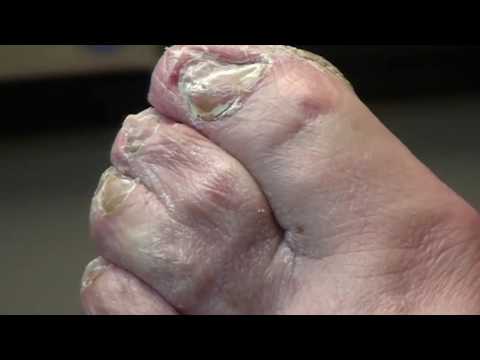 Thick Fungal Nails! Dr. Nail Nipper! 1