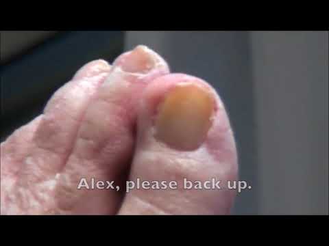Summer of Nails! Dr. Nail Nipper's BIG Clips! 1