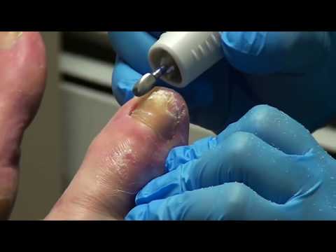 Thick Nails vs Medical Drill! Dr. Nail Nipper's Toenail Tuesday 1