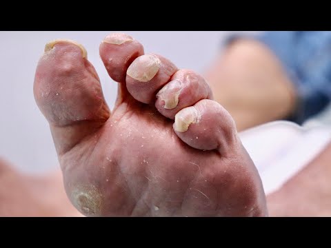 Trimming CURLED TOENAILS & Removing DEAD HARD SKIN 1