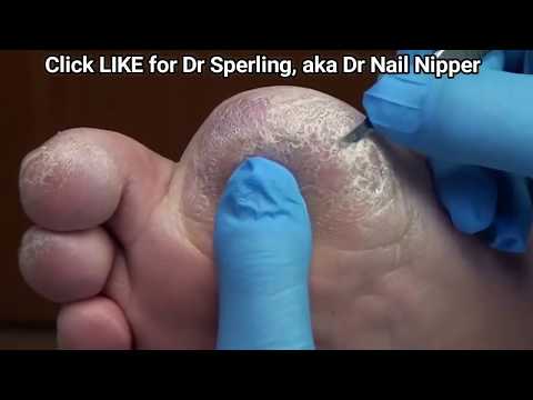 YouTube's Thickest Callus' and Amputee Nail Clipping - Dr. Nail Nipper 1