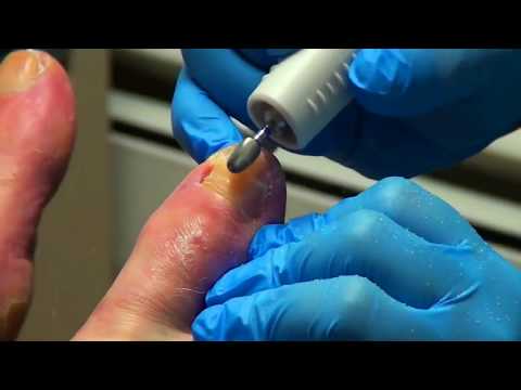 Thickest Fungal Nails Trimmed by Dr. Nail Nipper (Bonus Video!) 1 Thickest Fungal Nails Trimmed by Dr. Nail Nipper (Bonus Video!) 1