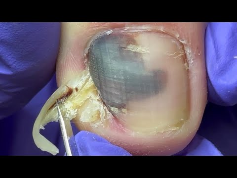 Infection in the middle of the toenail, a huge ingrown nail clipping【Doctor Liu Pedicure】 1