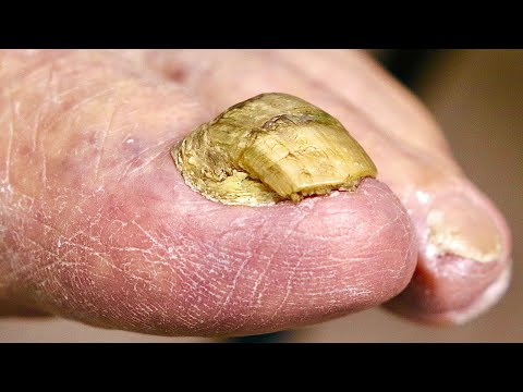 Super THICK BIG TOENAIL Trimming ***NAIL FUNGUS OR DAMAGED TOENAIL?!*** 1