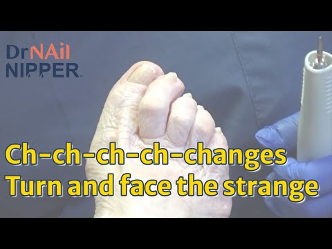 What is Changes and Thick Toenails. FEET-ure Friday (2022) 1