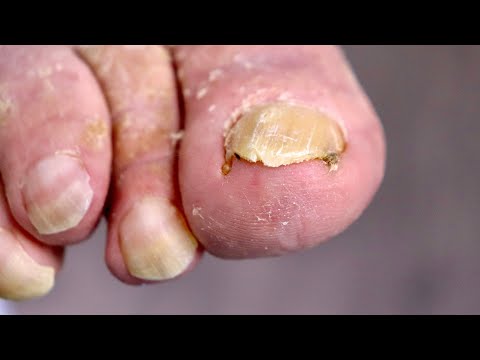 Trimming a PAINFUL INGROWN TOENAIL without SURGERY!!! 1